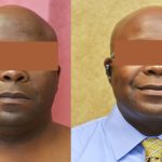 Male Neck & Face Liposuction Before & After Patient #13280