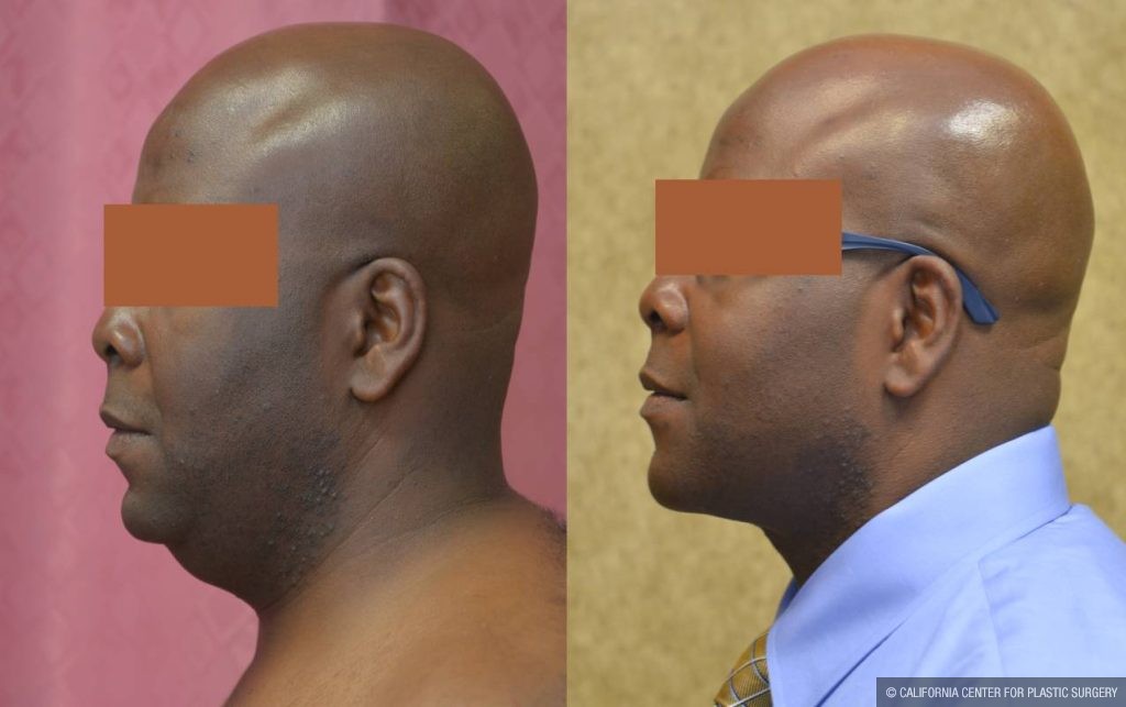 Male Neck & Face Liposuction Before & After Patient #13280