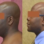 Male Neck & Face Liposuction Before & After Patient #13280