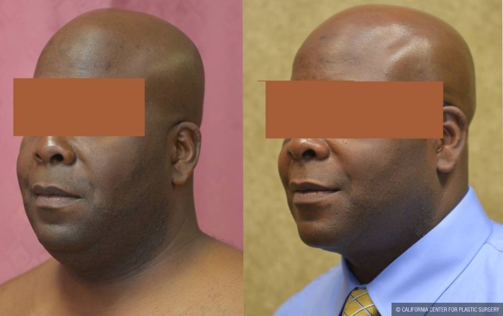 Male Neck & Face Liposuction Before & After Patient #13280