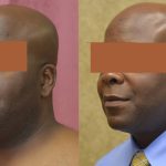 Male Neck & Face Liposuction Before & After Patient #13280