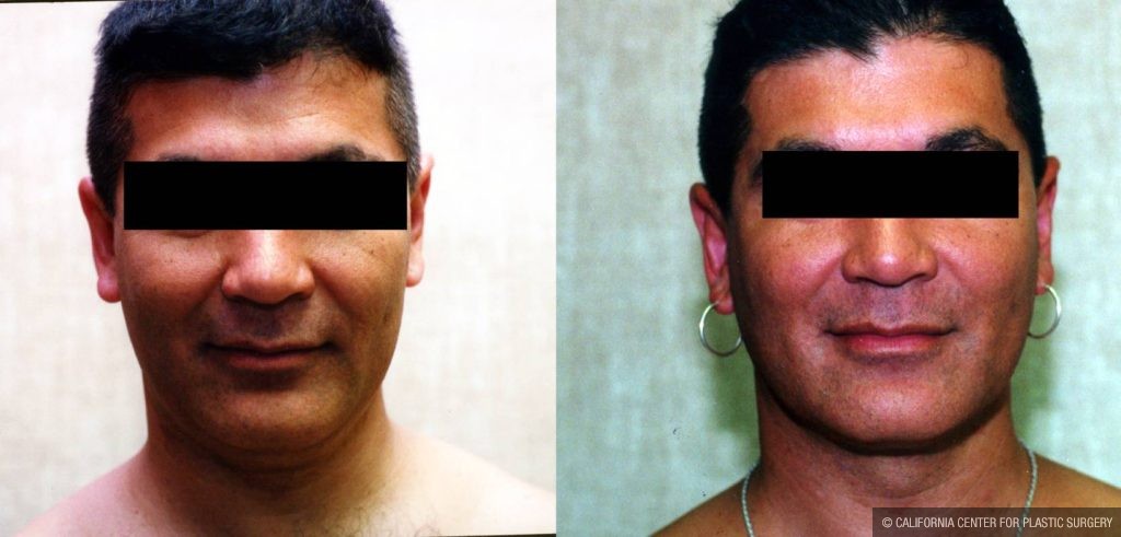 Male Neck & Face Liposuction Before & After Patient #13281