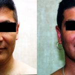 Male Neck & Face Liposuction Before & After Patient #13281