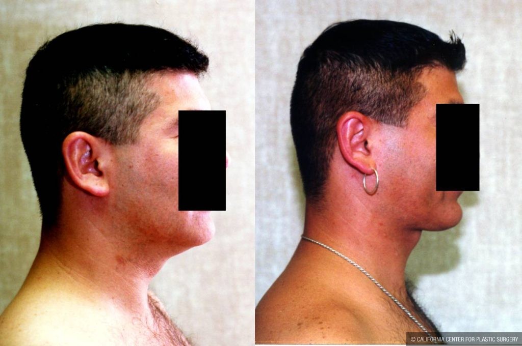 Male Neck & Face Liposuction Before & After Patient #13281