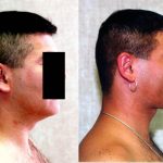 Male Neck & Face Liposuction Before & After Patient #13281