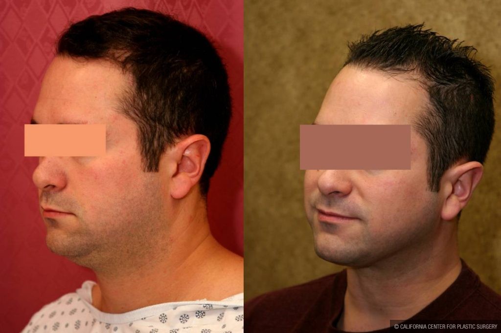 Male Neck & Face Liposuction Before & After Patient #13282