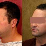 Male Neck & Face Liposuction Before & After Patient #13282