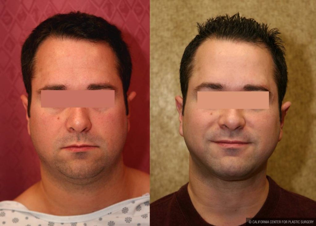 Male Neck & Face Liposuction Before & After Patient #13282