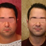 Male Neck & Face Liposuction Before & After Patient #13282