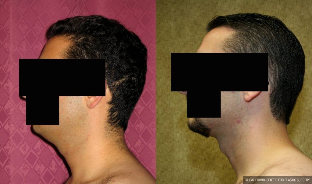 Male Neck & Face Liposuction Before & After Patient #13283