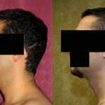 Male Neck & Face Liposuction Before & After Patient #13283