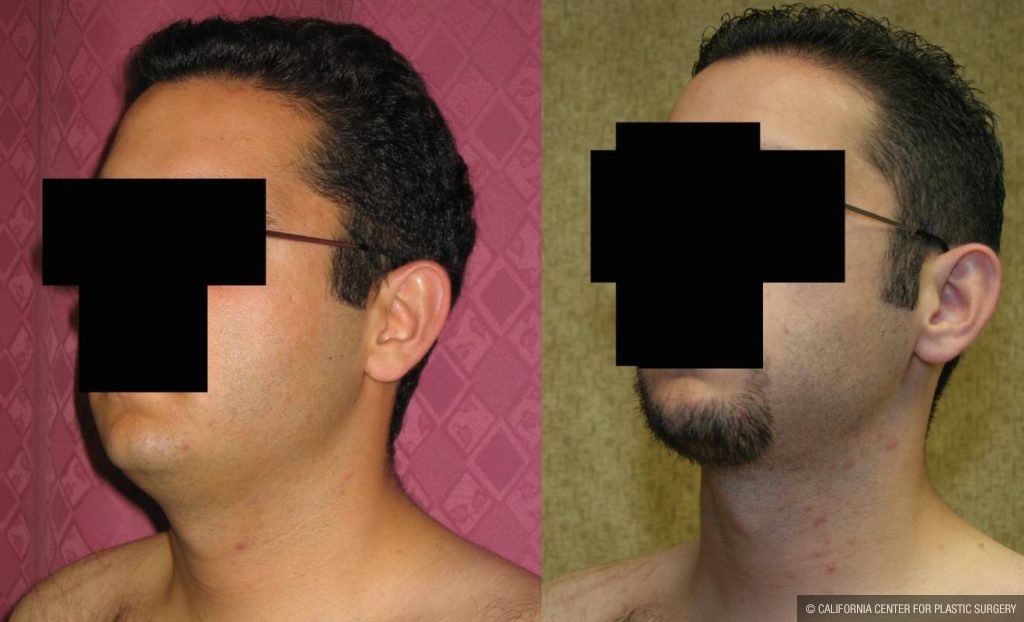 Male Neck & Face Liposuction Before & After Patient #13283