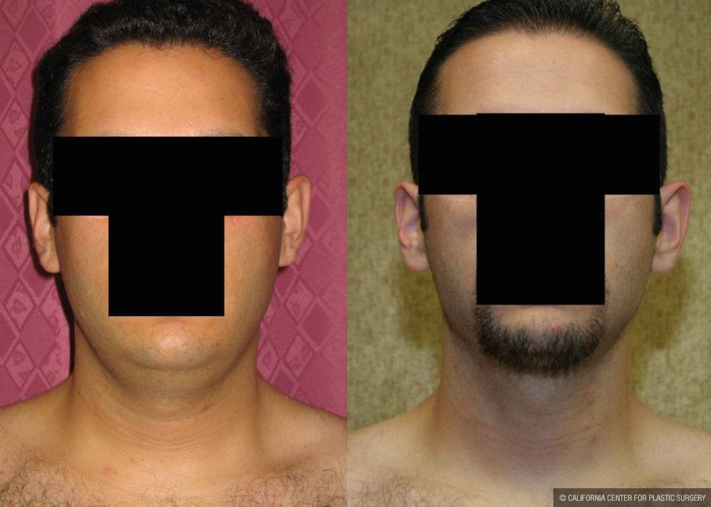 Male Neck & Face Liposuction Before & After Patient #13283