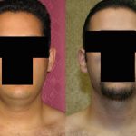Male Neck & Face Liposuction Before & After Patient #13283