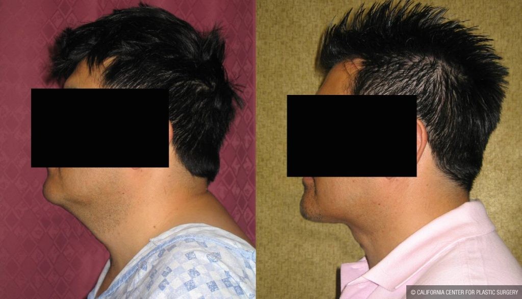 Male Neck & Face Liposuction Before & After Patient #13284