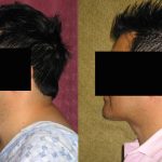Male Neck & Face Liposuction Before & After Patient #13284