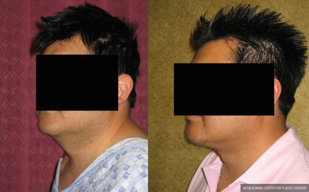 Male Neck & Face Liposuction Before & After Patient #13284