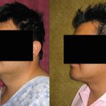 Male Neck & Face Liposuction Before & After Patient #13284