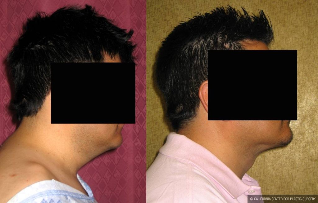 Male Neck & Face Liposuction Before & After Patient #13284