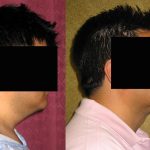 Male Neck & Face Liposuction Before & After Patient #13284