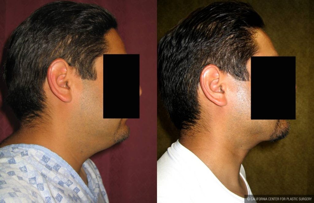 Male Neck & Face Liposuction Before & After Patient #13301