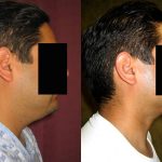 Male Neck & Face Liposuction Before & After Patient #13301