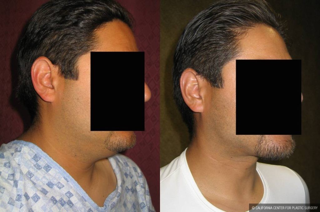 Male Neck & Face Liposuction Before & After Patient #13301