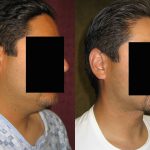 Male Neck & Face Liposuction Before & After Patient #13301