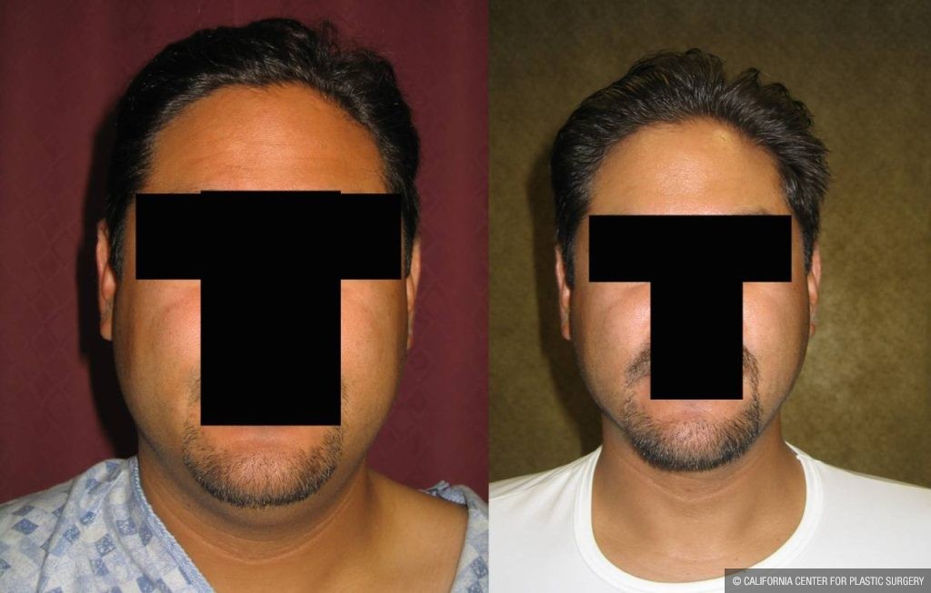 Male Neck & Face Liposuction Before & After Patient #13301