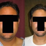 Male Neck & Face Liposuction Before & After Patient #13301