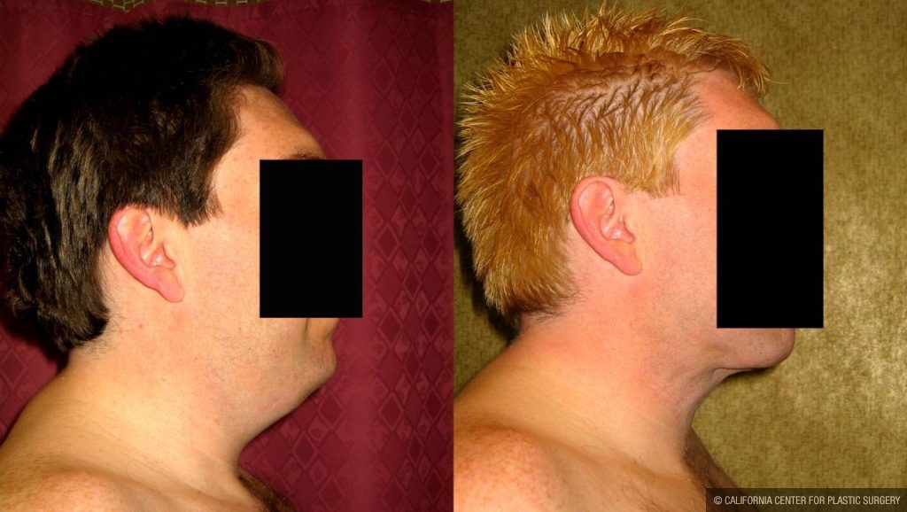 Male Neck & Face Liposuction Before & After Patient #13302