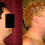 Male Neck & Face Liposuction Before & After Patient #13302