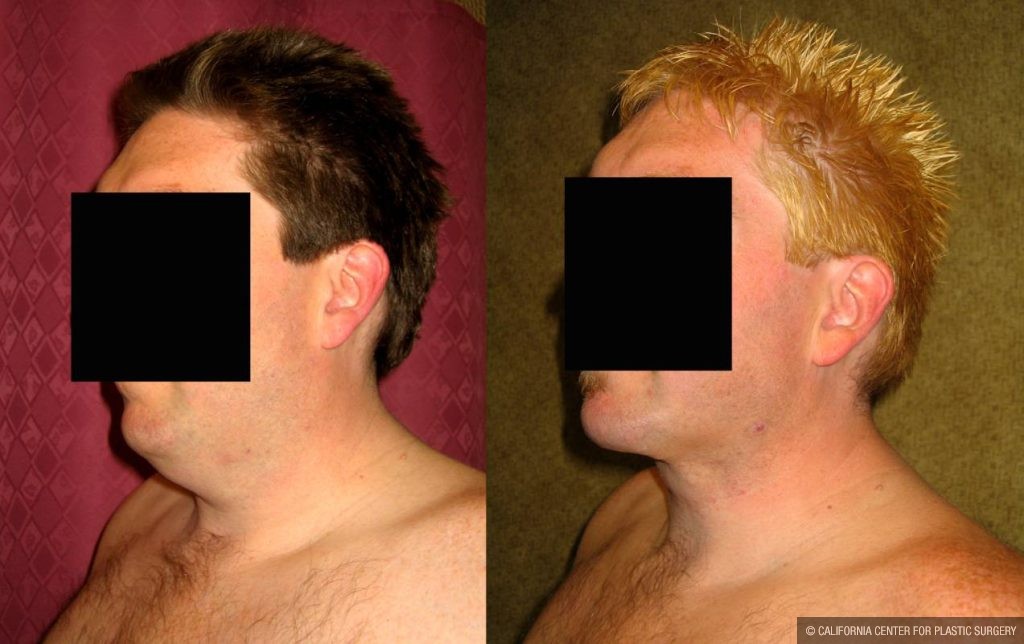 Male Neck & Face Liposuction Before & After Patient #13302