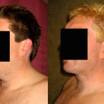 Male Neck & Face Liposuction Before & After Patient #13302
