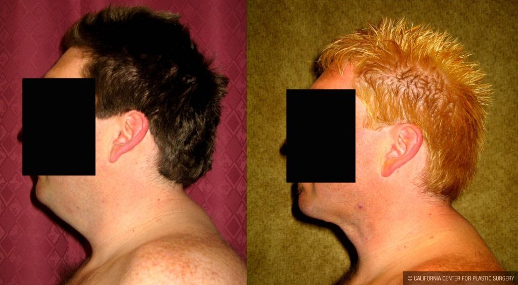 Male Neck & Face Liposuction Before & After Patient #13302