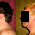 Male Neck & Face Liposuction Before & After Patient #13302