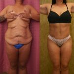 Body Lift Before & After Patient #13402