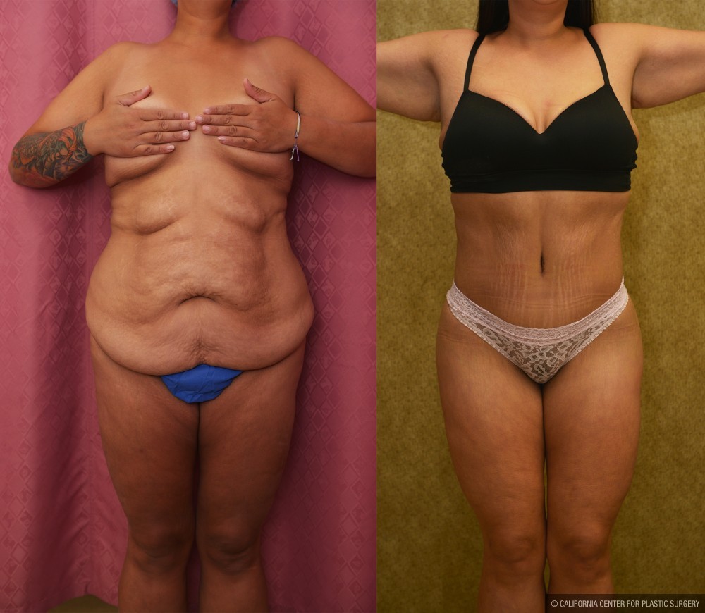 Body Lift Before & After Patient #13402