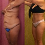 Body Lift Before & After Patient #13402