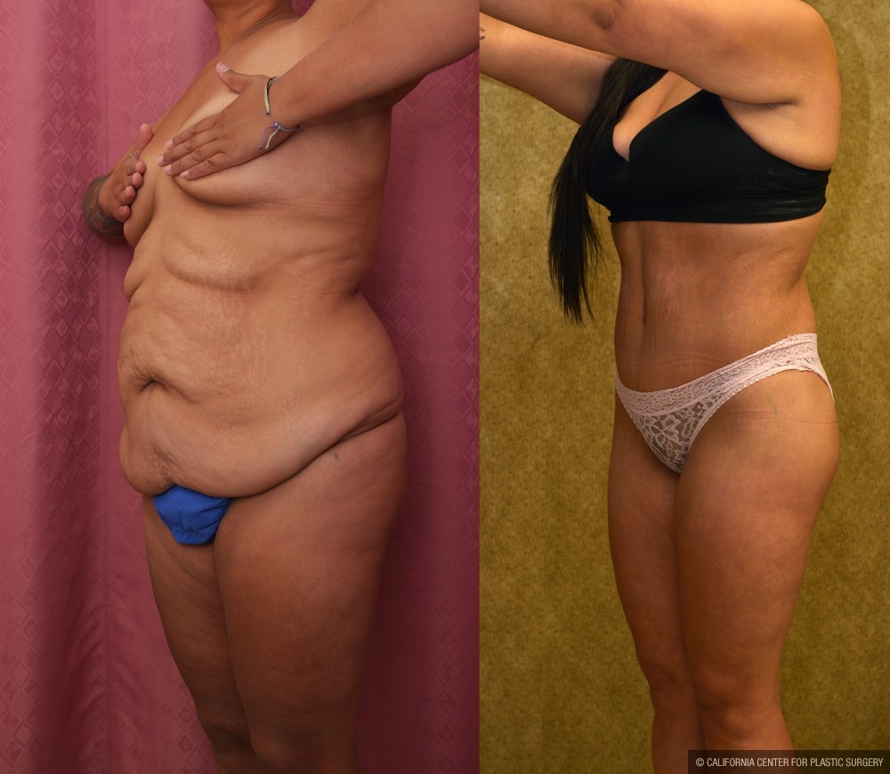 Body Lift Before & After Patient #13402