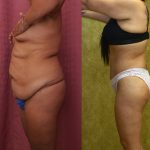 Body Lift Before & After Patient #13402