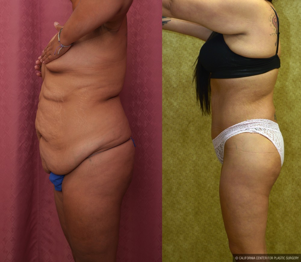 Body Lift Before & After Patient #13402