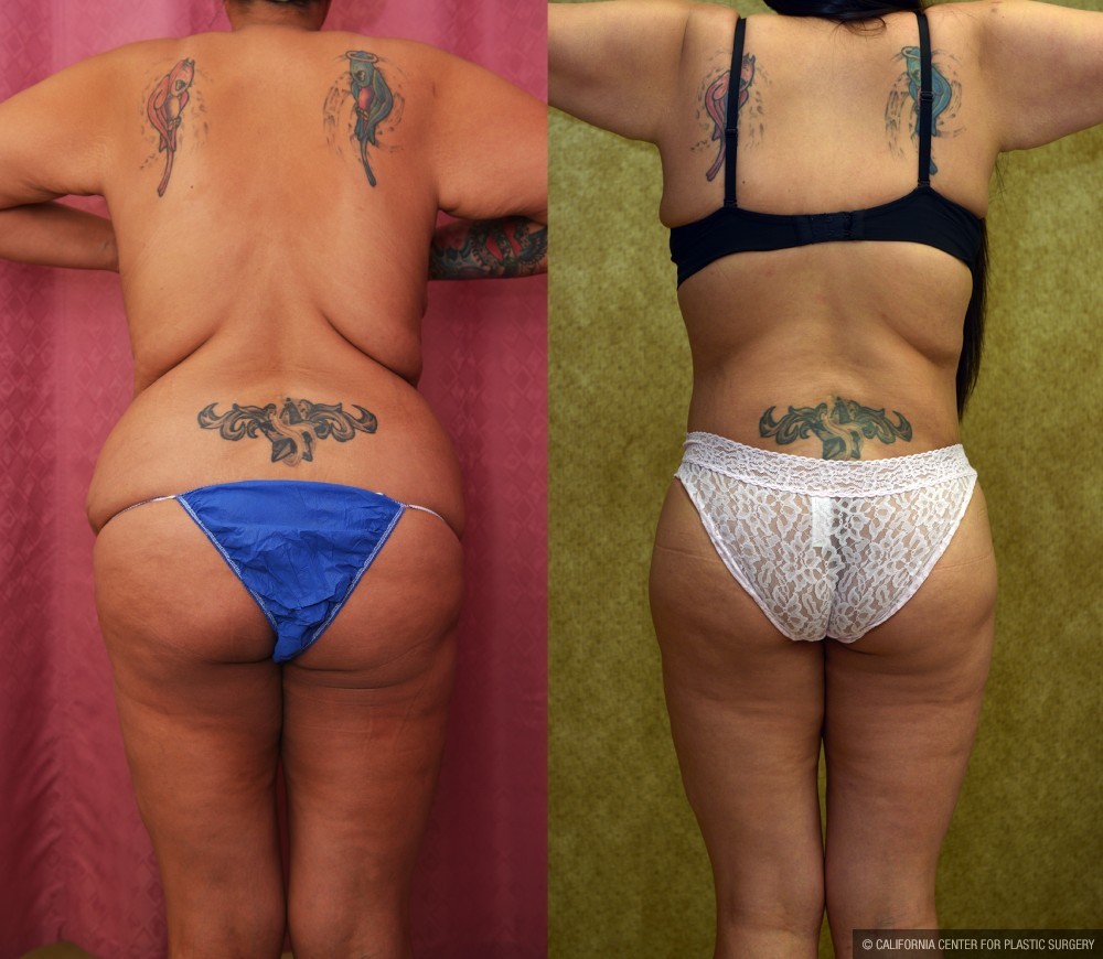 Body Lift Before & After Patient #13402