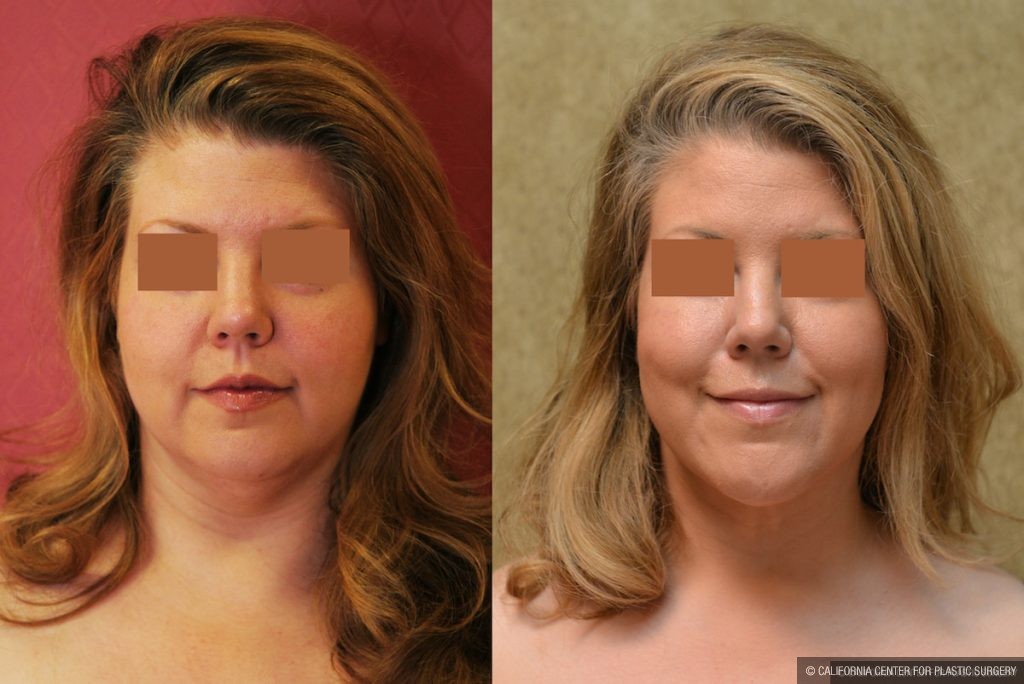 Neck & Face Liposuction Before & After Patient #13398
