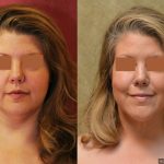 Neck & Face Liposuction Before & After Patient #13398