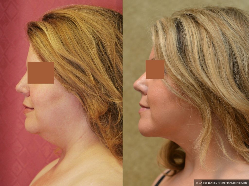 Neck & Face Liposuction Before & After Patient #13398