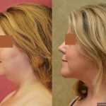 Neck & Face Liposuction Before & After Patient #13398