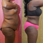 African American Tummy Tuck (Abdominoplasty) Before & After Patient #13465