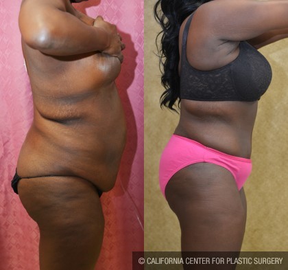 African American Tummy Tuck (Abdominoplasty) Before & After Patient #13465