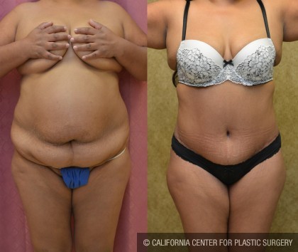 African American Tummy Tuck (Abdominoplasty) Before & After Patient #13460